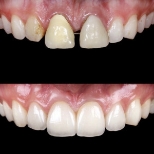 Smile Designing