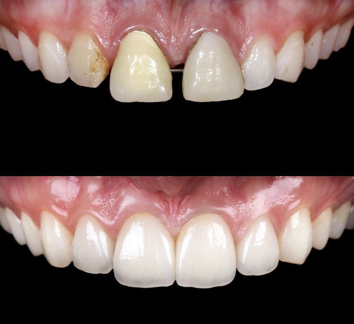 Smile Designing