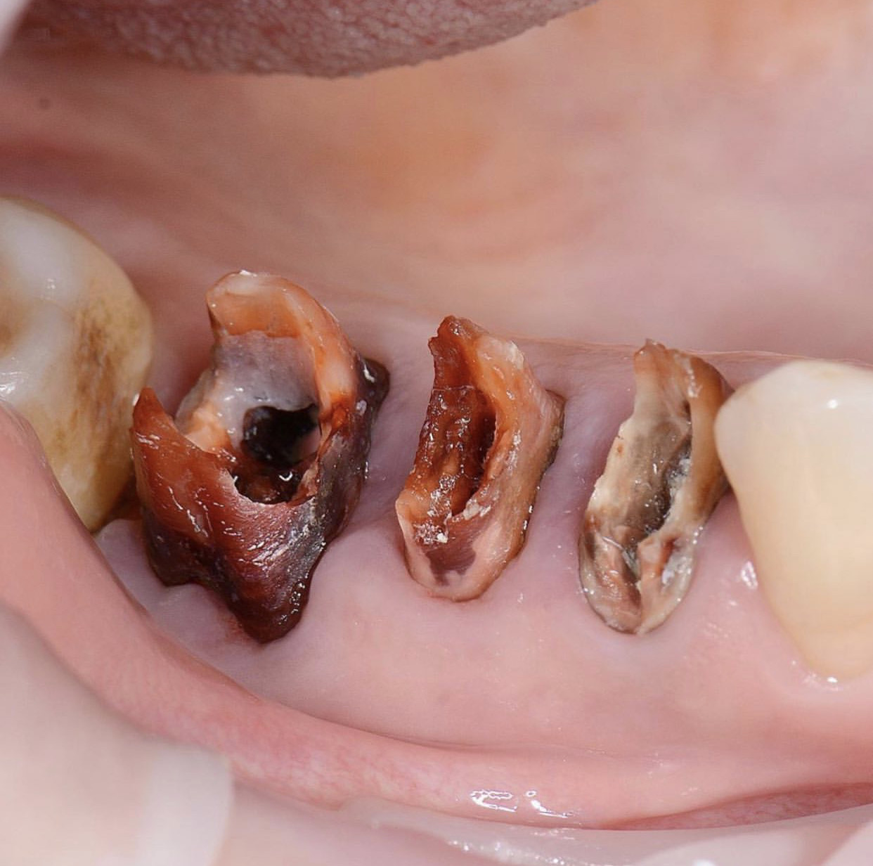 Root Canal Treatment