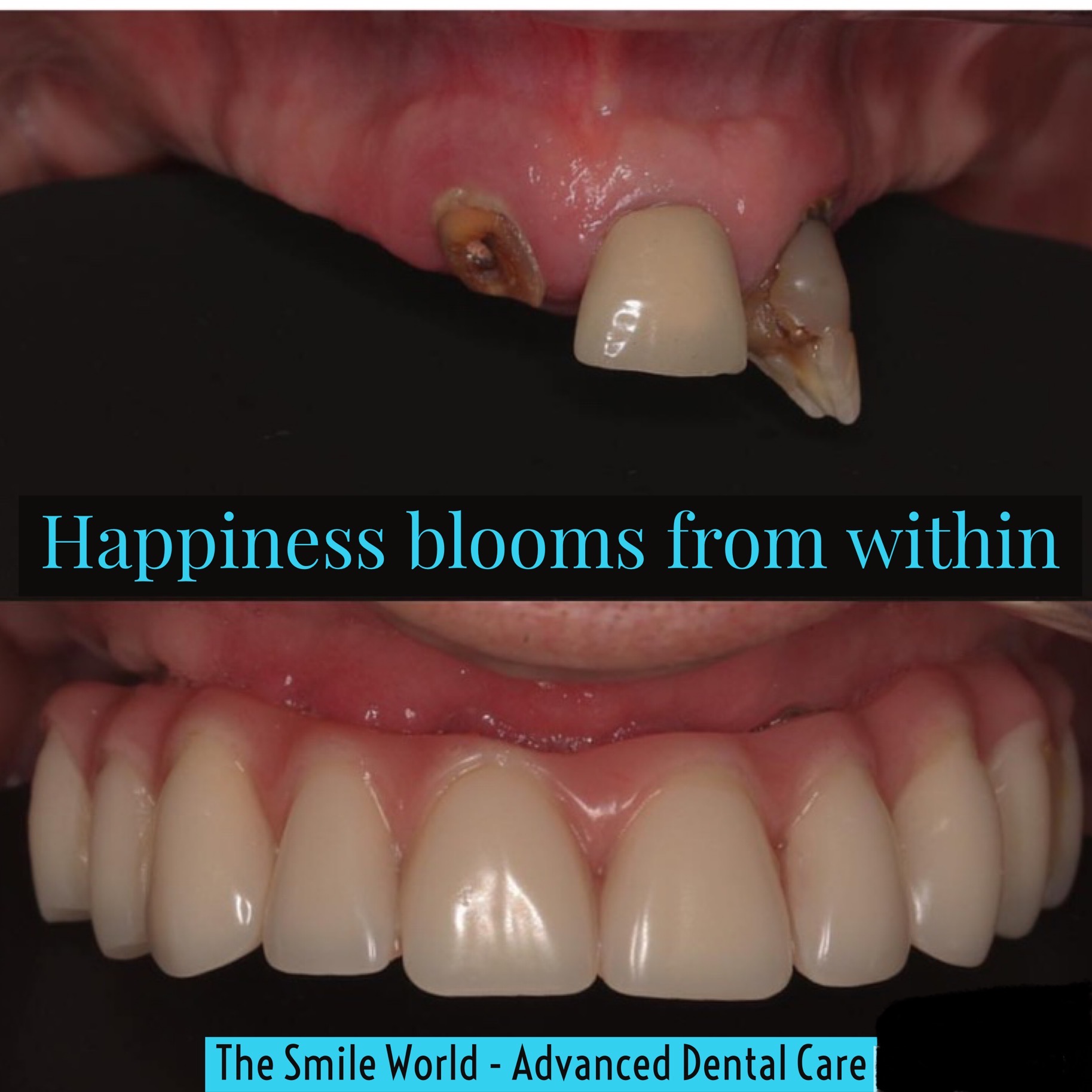 Dental Implants